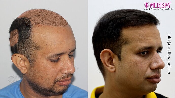 Dr. Suneet Soni - 4500 Grafts, Combine FUT + FUE Technique, NW-III photo