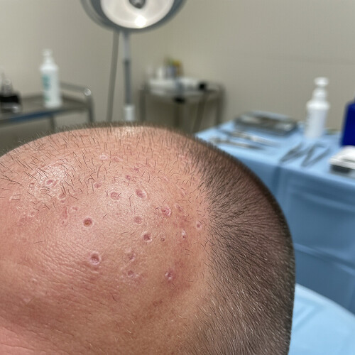 FUE hair transplant donor site scarring