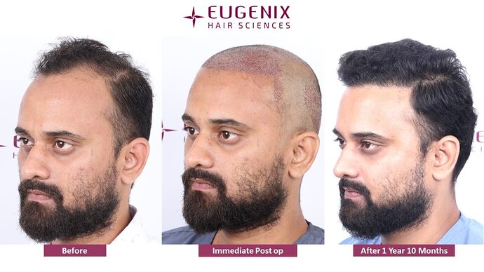 Eugenix Hair Sciences Clinic | Norwood Grade 3 | 22 Months Hair Transplant Results| photo