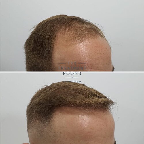 2190 Grafts Hairline Transplant- The Treatment Rooms London photo