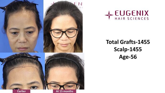 Dr. Pradeep Sethi| Eugenix Hair Sciences Clinic| 1455 Grafts | 15 Months Post-op| Female Hair Transplant photo