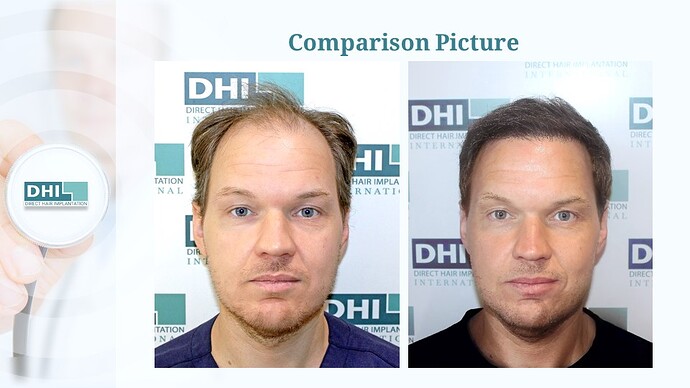 DHI India™ | NW 6 | 2,507 Grafts | 4 Months Hair Transplant Results photo