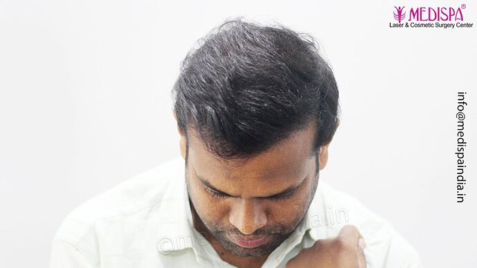 Dr. Suneet Soni - 5498 Grafts, 2 Years Result, Combine FUT + FUE + Beard Technique, NW-VI photo