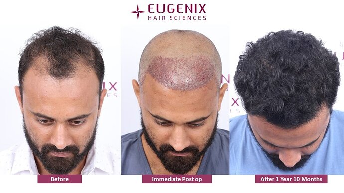 Eugenix Hair Sciences Clinic | Norwood Grade 3 | 22 Months Hair Transplant Results| photo