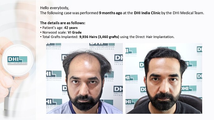 DHI India | NW 6 | 3,460 Grafts | 9-Months DHI Hair Transplant Results photo
