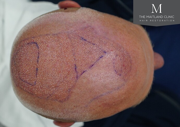 Dr Ball - The Maitland Clinic 2280 Grafts by FUE photo