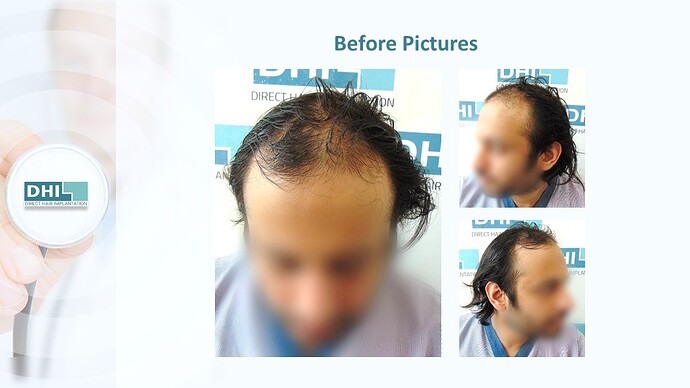 DHI India™ | NW 4 | 3,714 Grafts | 2 Years DHI Hair Transplant Result photo