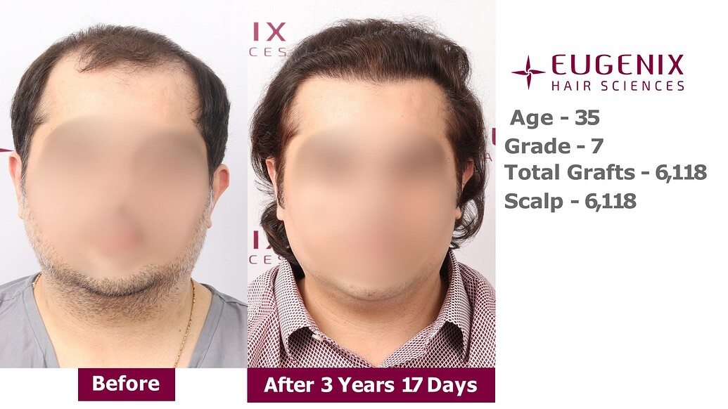 https://cdn.forumhairtransplant.com/optimized/3X/d/5/d56f5a26adf9929823a4ec1075e3b4d7d43c0743_2_1035x582.jpeg