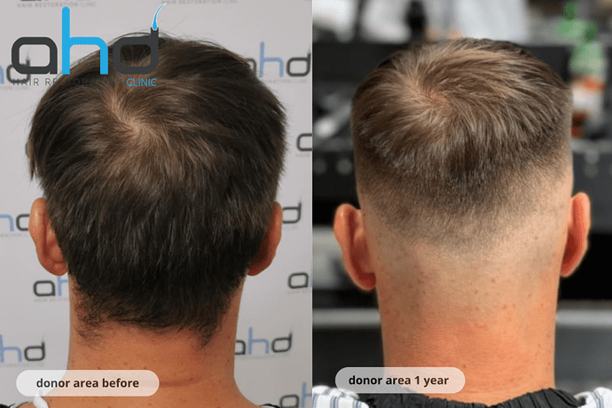 AHD Clinic / Technicians / 2250 grafts / FUE + DHI photo
