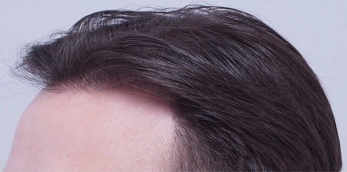 Dr Bessam Farjo FUE 1720 grafts to frontal recessions photo