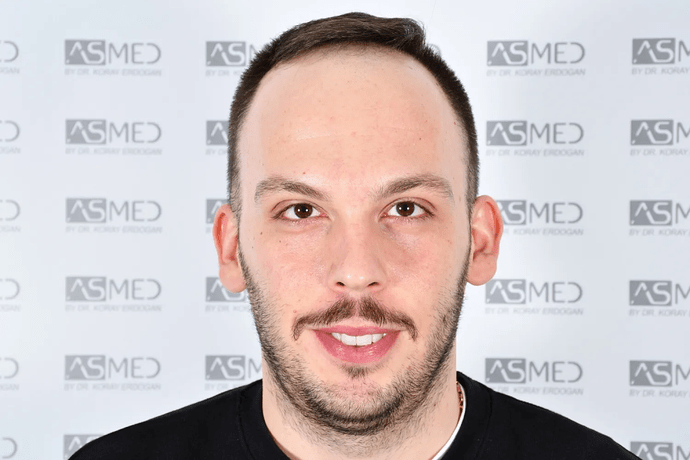 ASMED, Istanbul: 5,071 Manual FUE Grafts 0/12 Months photo