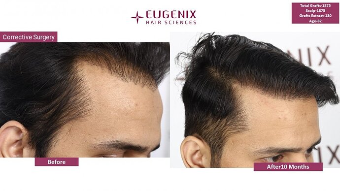 Corrective Hair Transplantation | Hairline Correction I 7 months update @Eugenix Hair Sciences photo