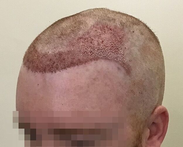 Dr. Bisanga, BHR Clinic, 2500 FUE / 0-8,5 Months photo