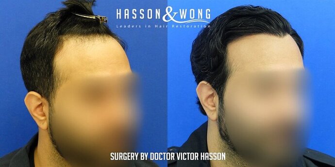 Dr. Hasson / 2,500 grafts / FUE / Hairline / 1 Year Post-op photo