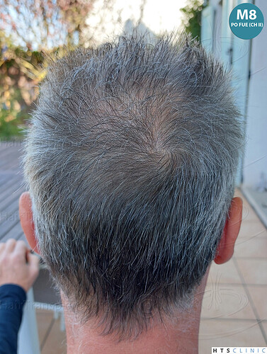 Dr Devroye + Dr Montesanti + Dr Jenard / 7015 grafts (4512 FUT + 2503 FUE) / 2 sessions photo