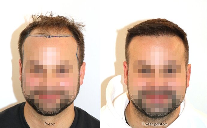 Case performed by Dr. Feriduni – 3726 FU in 1 procedure photo