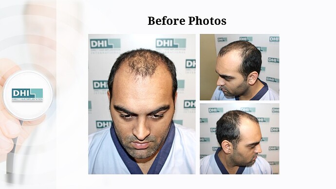 DHI India | NW 5 | 3,080 Grafts | 20-Months DHI Hair Transplant Results photo