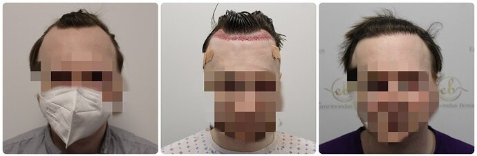 Dr Bonaros, Glasgow, UK / 1614 FUE grafts for receding Hairline / 0-12 Months photo