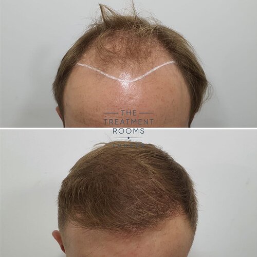 2190 Grafts Hairline Transplant- The Treatment Rooms London photo