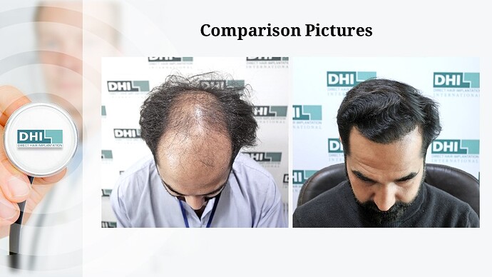 DHI India | NW 6 | 3,460 Grafts | 9-Months DHI Hair Transplant Results photo