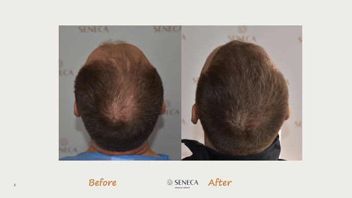 Seneca Medical Group - 3189 grafts with Direct Fue photo