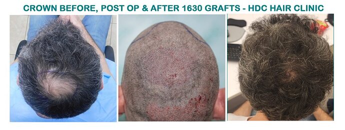 Result of Class 3V Patient – 3530 Grafts – HDC Hair clinic – Dr Maras photo