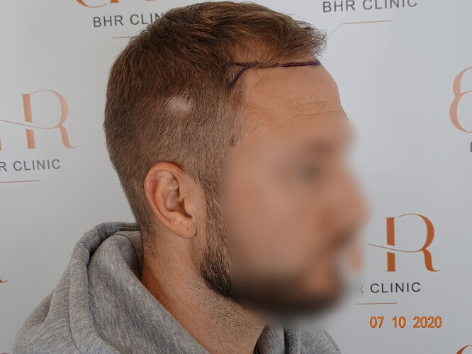 Dr.Bisanga, BHR Clinic Brussels 3251 FUE 0 - 8 Months photo