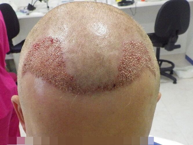 Dr. Bisanga, BHR Clinic. 2151 FUE. 0-8 Months photo