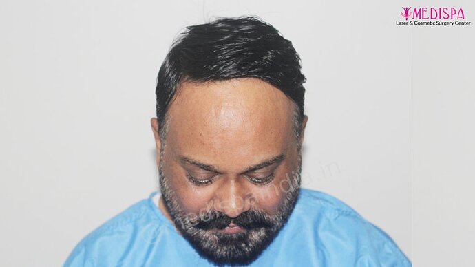 Dr. Suneet Soni - 4190 Grafts, Combine FUT + FUE + Beard Technique, NW- III photo