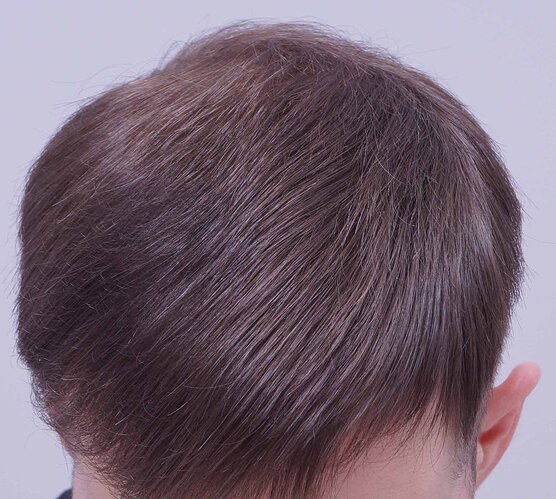 Dr B Farjo 1560g FUE (Frontal) photo
