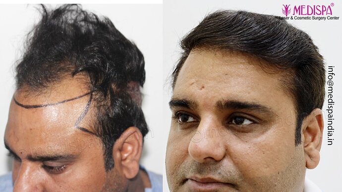 Dr. Suneet Soni - 4500 Grafts, 3 Year Result, NW-IV, Combine FUT + FUE Technique photo