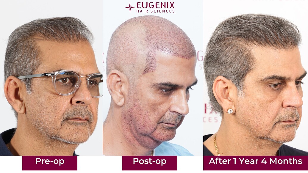 https://cdn.forumhairtransplant.com/optimized/3X/d/8/d8420bd40954c3ad21a415b202a2041129483dfc_2_1035x582.jpeg