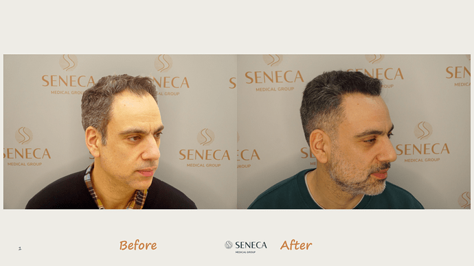 Seneca Medical Group - 2065 grafts with Direct Fue photo