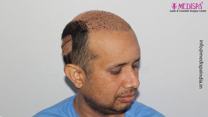 Dr. Suneet Soni - 4500 Grafts, Combine FUT + FUE Technique, NW-III photo