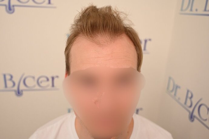 Ozlem Bicer MD-Hair Transplant-2720 Grafts FUE by micro-motor, 9. months result photo