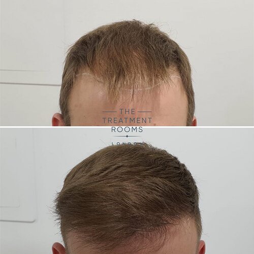 1717 Grafts Result Hairline Hair Transplant photo