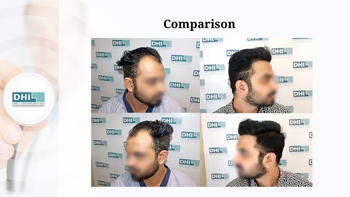 DHI India | Hair Line Reconstruction | Grade 3 | 2,088 Grafts | 10 Months Hair Transplant Results photo