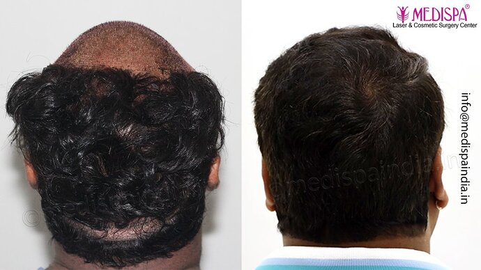 Dr. Suneet Soni - 4500 Grafts, 3 Year Result, NW-IV, Combine FUT + FUE Technique photo