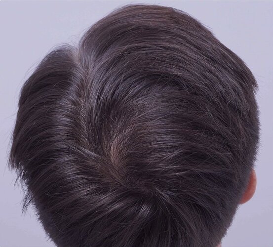 Dr Bessam Farjo FUE 1720 grafts to frontal recessions photo