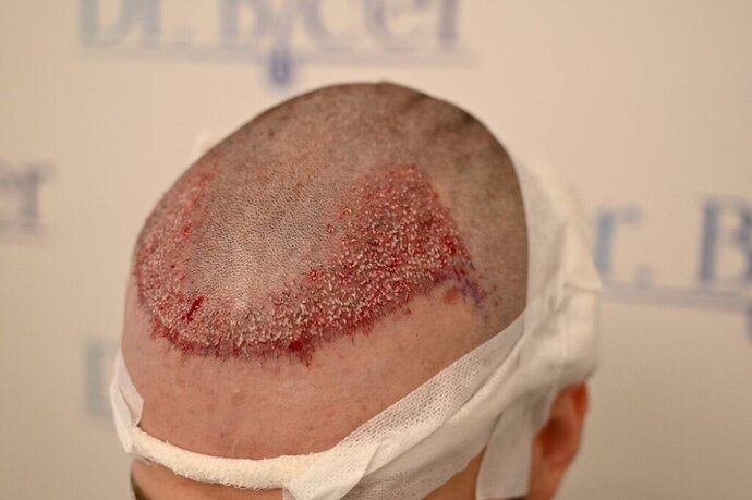 Ozlem Bicer MD-2340 Grafts FUE by micro-motor, 12. month result  photo