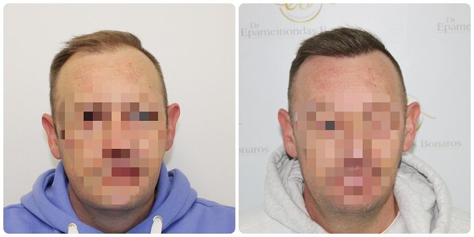 Dr Bonaros, Glasgow, UK / Receding Hairline Hair Transplant Result / 1814 FUE grafts / 0-12 Months photo