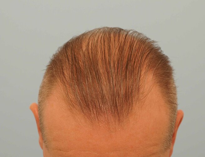 Dr B Farjo 1700g FUE (Front) photo