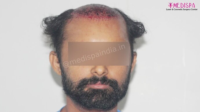 Revision Hair Transplant - 5111 Grafts / 5 Years Result - Dr. Suneet Soni, Medispa India photo