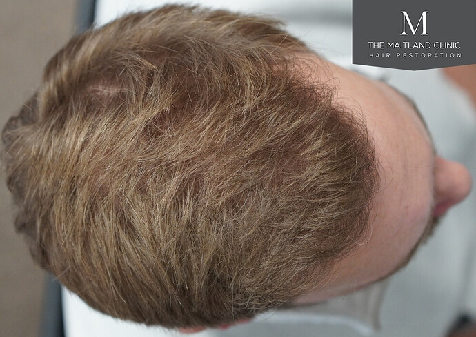 1826 grafts by FUE with Dr Edward Maitland Ball at The Maitland Clinic photo