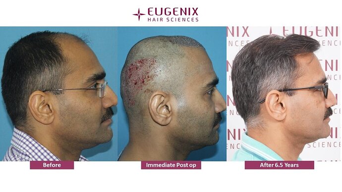 EUGENIX HAIR SCEINCES | GRADE 4 | 6 YEAR 5 MONTHS RESULT photo