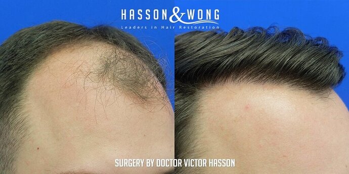 Dr. Hasson / 4,511 grafts / FUE / Frontal zone /mid / 3 years post-op photo