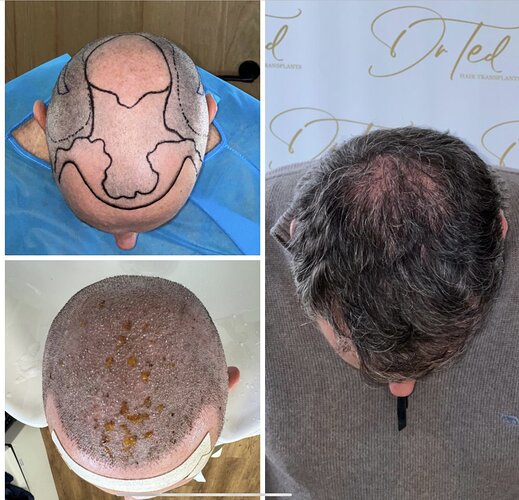 Dr Ted Miln (UK) | 6,120 grafts | FUT+FUE combo | Hairline, midscalp & crown restoration | 8.5 months post-op photo