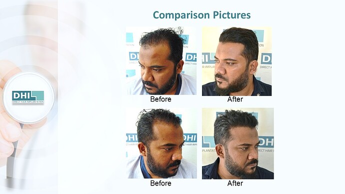 DHI India™ | NW 3 | 4,821 Grafts | 1 year DHI Hair Transplant Results photo