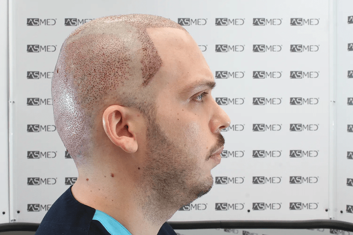 ASMED, Istanbul: 5,071 Manual FUE Grafts 0/12 Months photo