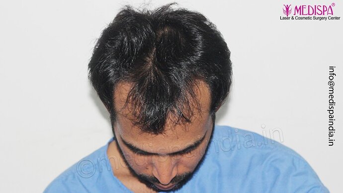 Dr. Suneet Soni - 3029 FUE Grafts, FUE Method (Trivellini System), NW - III photo